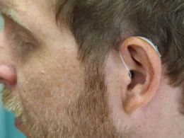 Chirurgia plastyczna uszu - przygotowanie do zabiegu